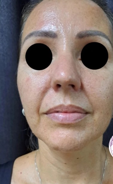 Rosto da cliente antes do tratamento