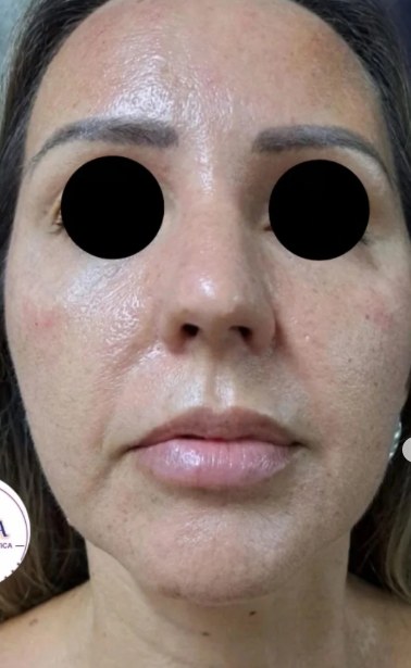 Rosto da cliente depois do tratamento